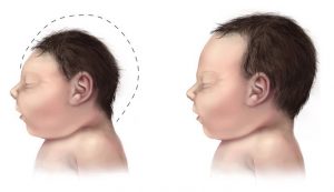 microcephaly illustration