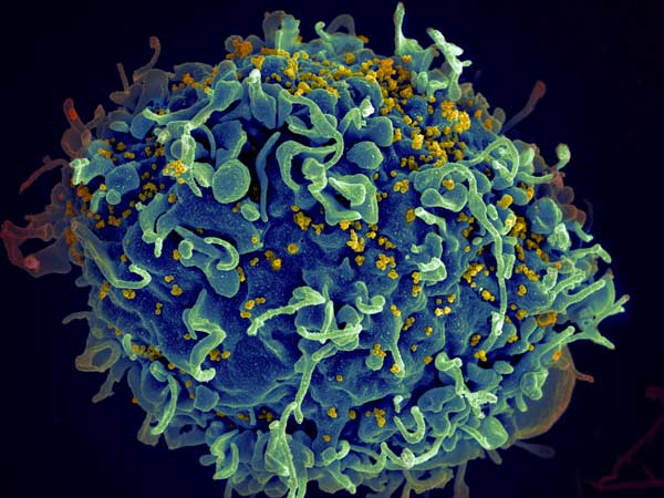 This human T cell (blue) is under attack by HIV (yellow), the virus that causes AIDS. Credit: Seth Pincus, Elizabeth Fischer and Austin Athman, National Institute of Allergy and Infectious Diseases, National Institutes of Health